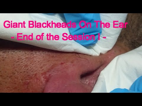 Giant Blackheads   – End of the Session I –