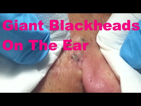Giant Blackheads  – Part I –