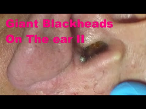 Giant Blackheads  – Part II-
