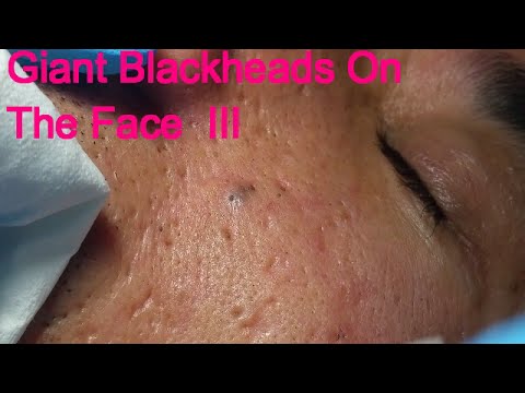 Giant Blackheads  – Part III –