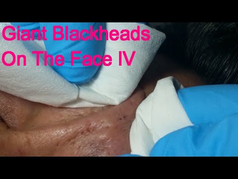 Giant Blackheads – Part IV-