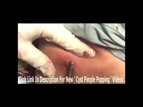 Giant cyst BOIL with Pus removal & popping   YouTube