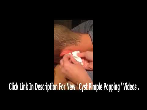 Giant Cyst Popping on Ear