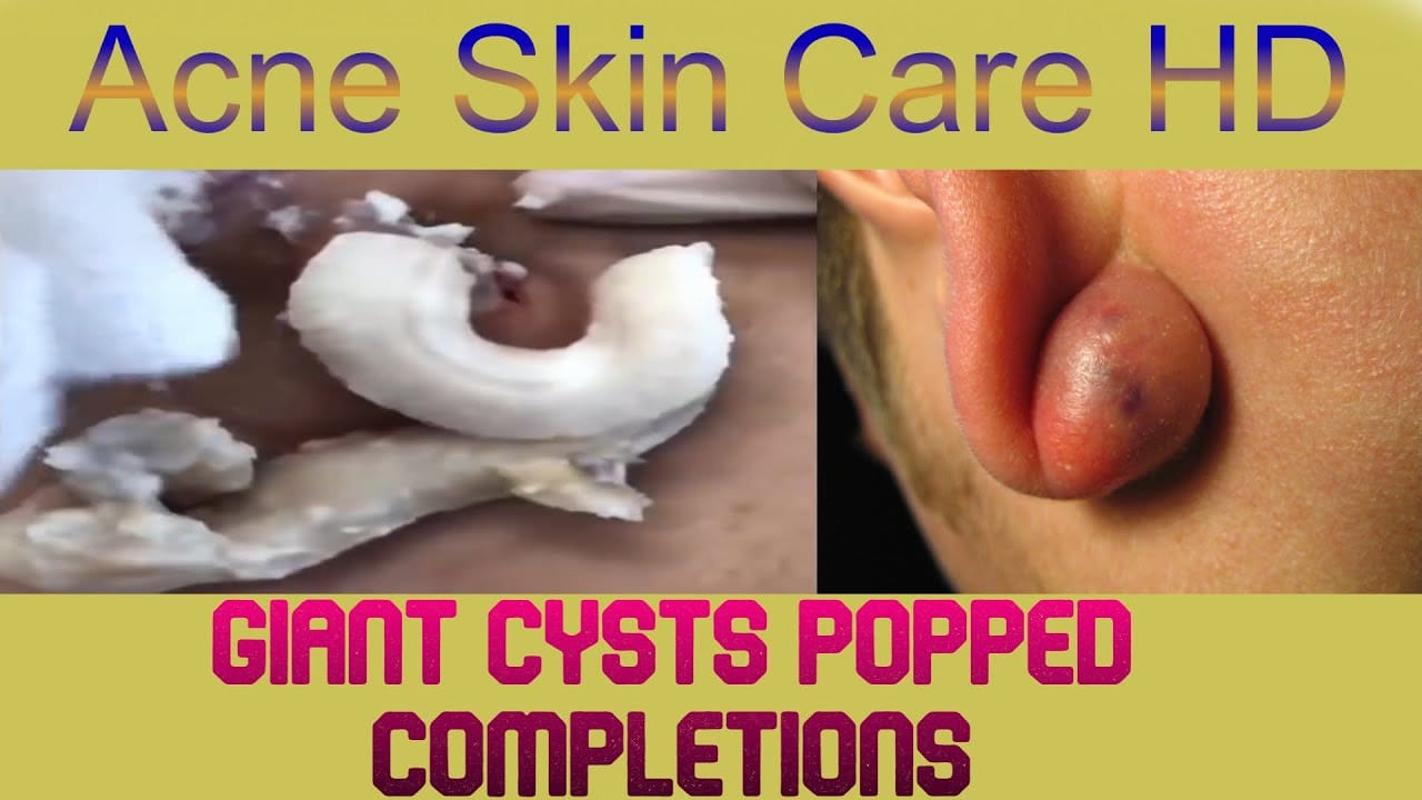 Giant Cysts Popped Completions EP9