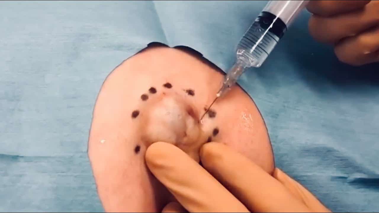 GIANT Cysts Removal BEST POPS Compilation | ft. Calm music & Commentary