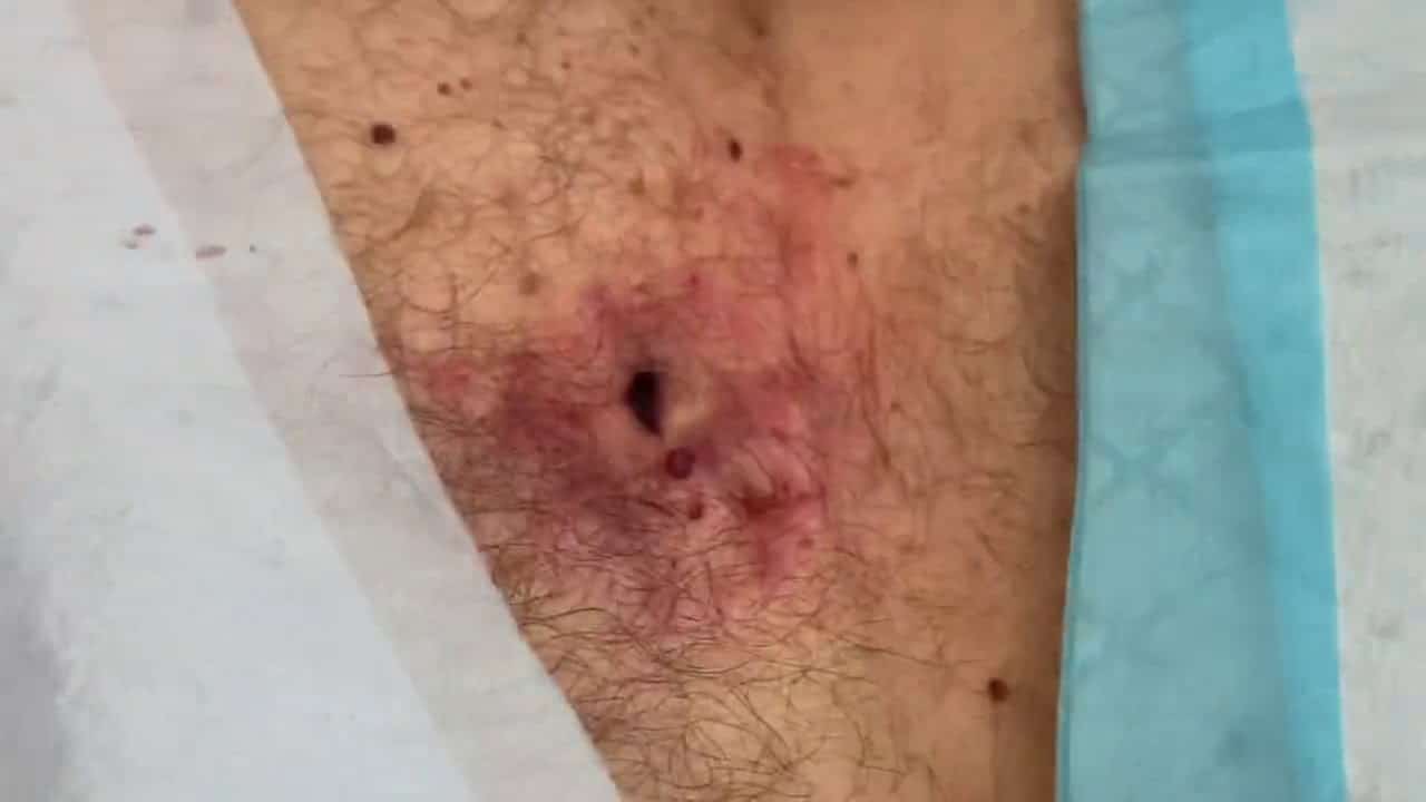 Giant exploded deep sternal abscess. I+D. Large pus pocket with cyst contents drained and packed.