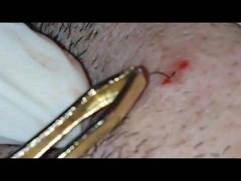 Giant ingrown hair infected2019,how to removal blackhead and acne  on face?