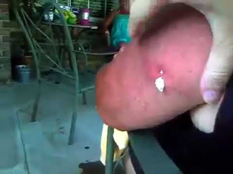 Giant Pimple Popping Exploding from the father’s arm.