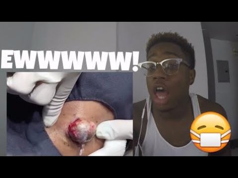 GIANT PIMPLE POPPING !! | REACTION