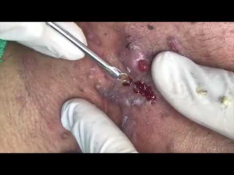 Giant Pimple Popping