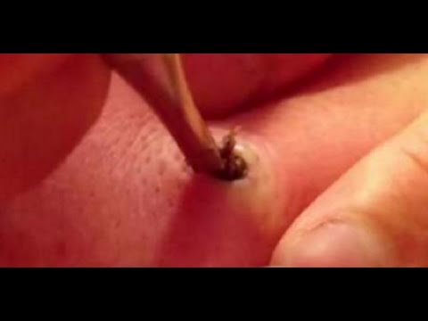 GIANT PUS PIMPLE EXTRACTION!!