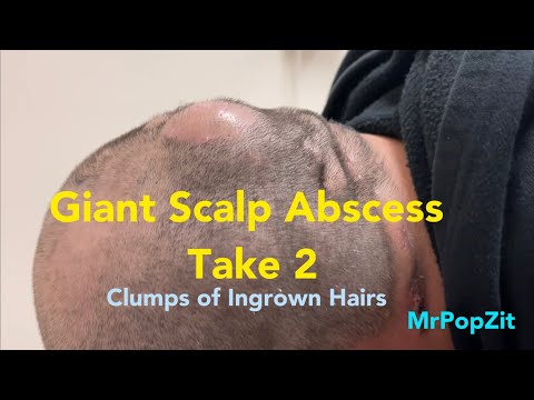 Giant scalp Abscess drained with clumps of long hairs removed and deep sinus tracts explored.