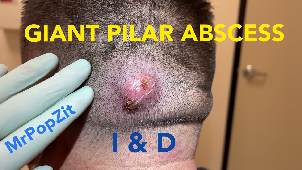 Giant Scalp Abscess with F/U’s. Swelling and VERY painful.Incision & Drainage done.Wait till the end