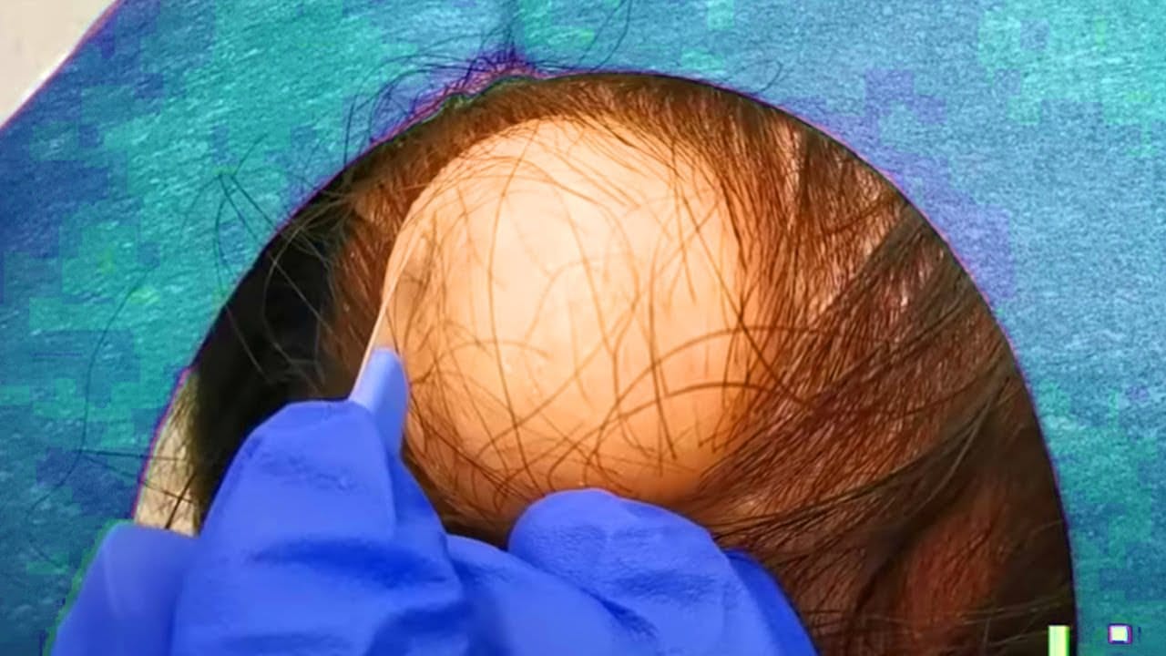 Giant Scalp Cyst Popping!  DB's Pilar Cyst Removal!