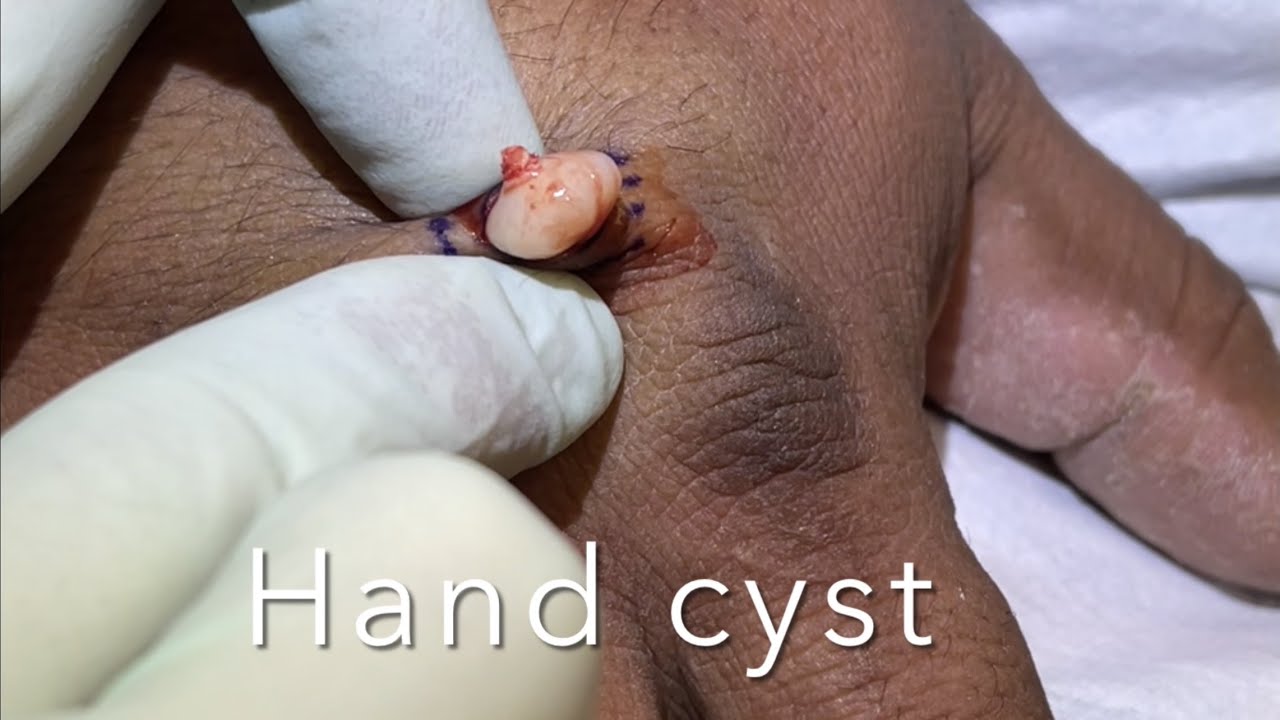 Give us a Hand Cyst. Cyst on back of hand popped out and dissected. Hand cyst. Cyst excision.