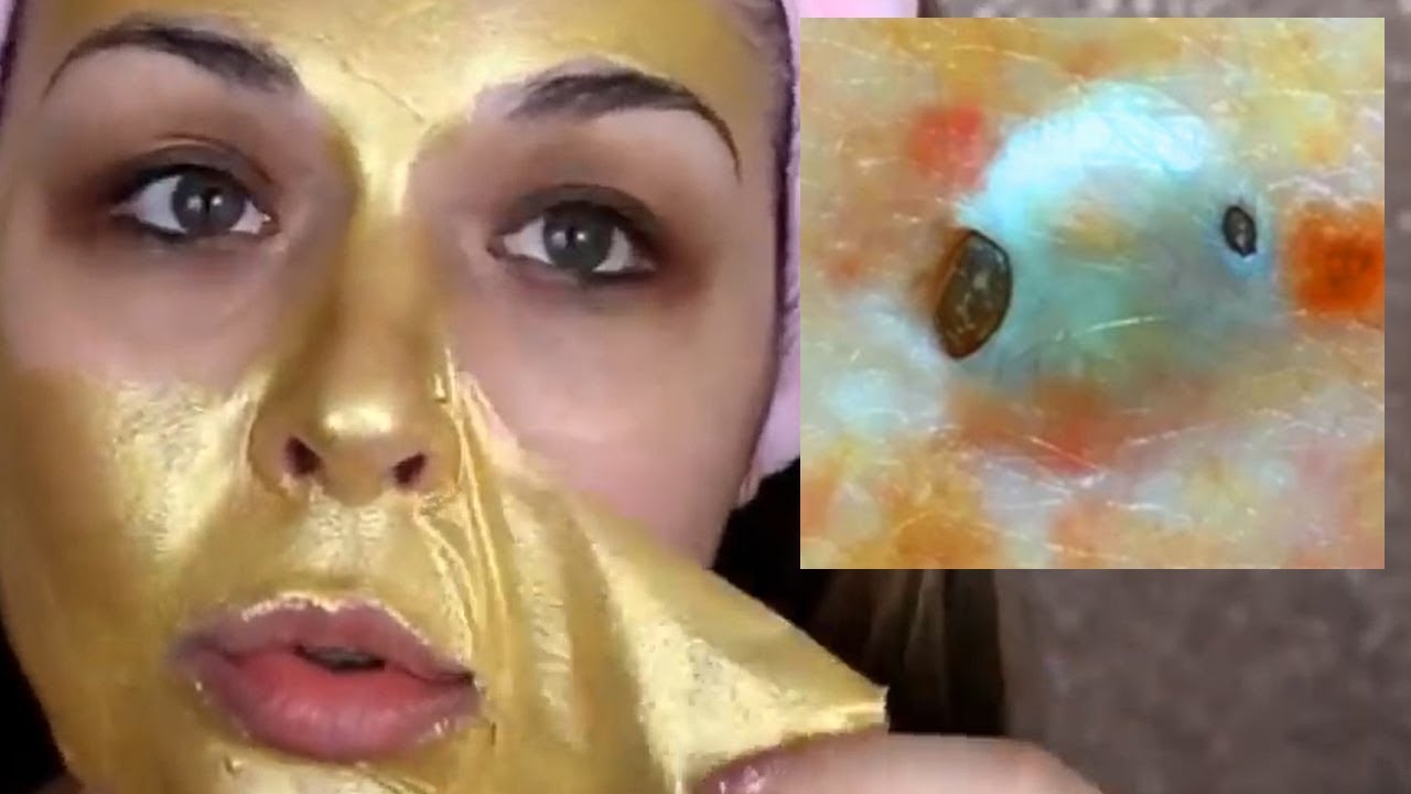 Gold Mask Peels and Pimple Popping!  Will They Stop Wrinkles?