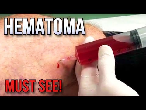 Golden Hematoma!  Big Mass in Thigh!  NEW CYSTS, POPS & PIMPLES