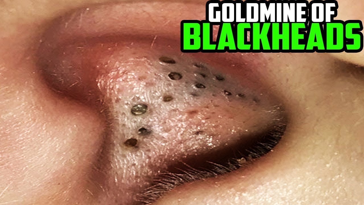 Goldmine of Blackheads in Ear!
