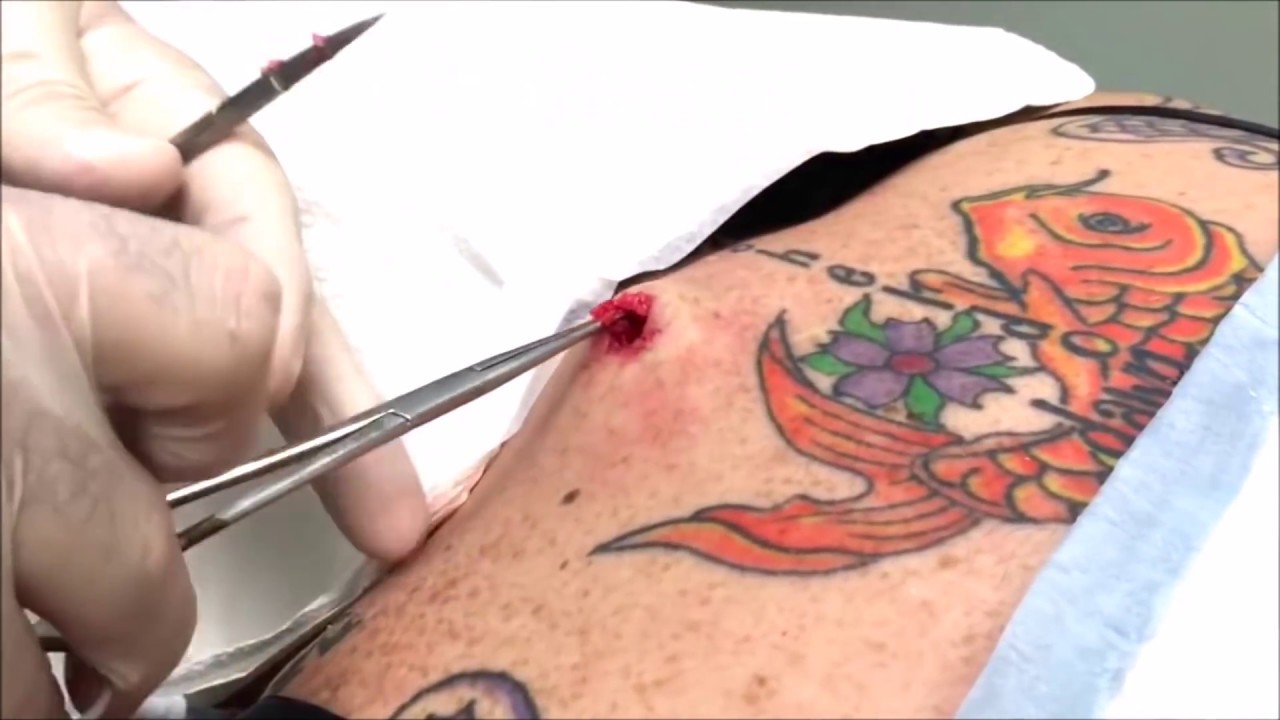 Gorgeous Cyst Removal!  Cyst Busting & Pimple Popping