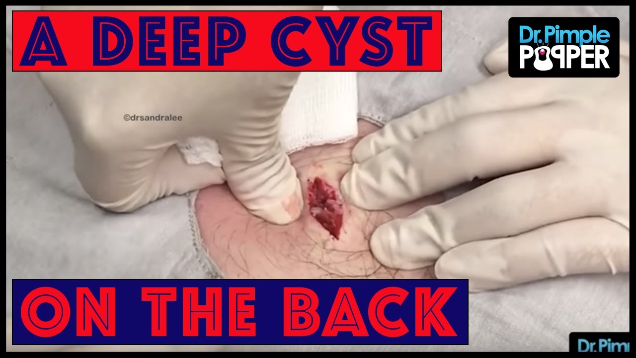 Got to go DEEP with THIS Cyst on the Back