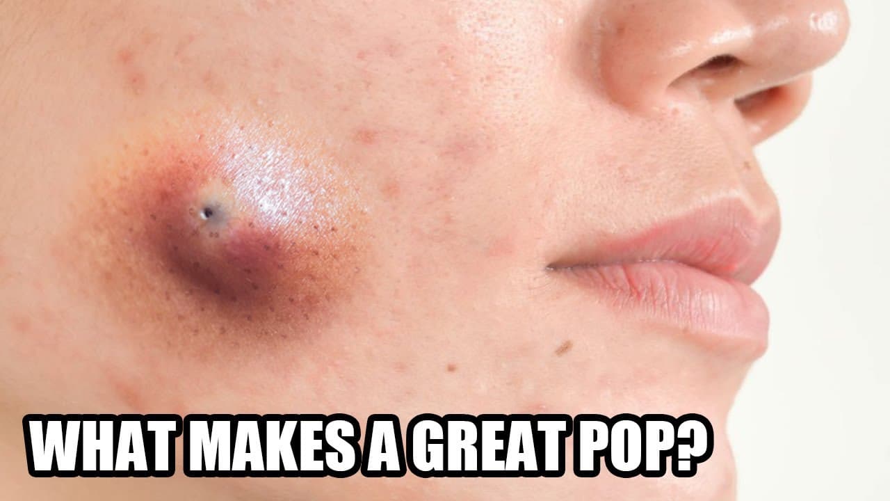 Greatest Cysts!  What Makes A Great Pimple Pop and Blackhead