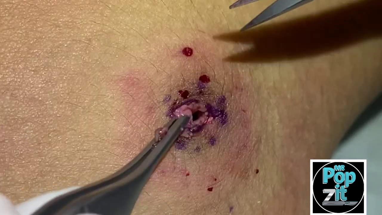 Grey peanut butter cyst. Cyst near armpit under pressure, grey pasty cyst pop Excision and closure.