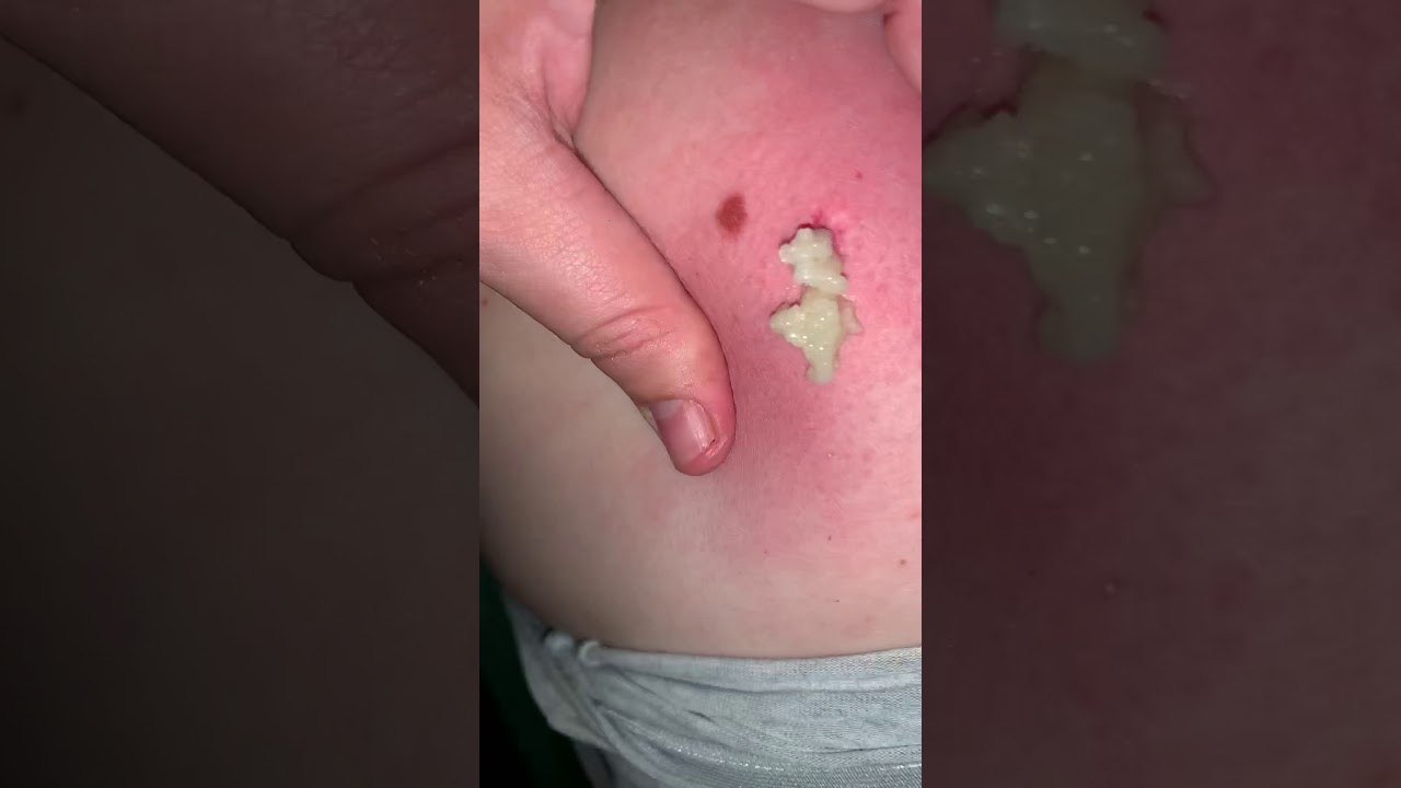 Gross but Satisfying Pimple POP