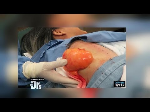 Gross Dr. Pimple Popper Videos