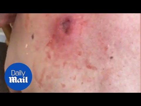 Gross moment a 25-year-old cyst is popped and oozes pus – Daily Mail