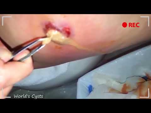 Grossest cyst pop you’re ever likely to see as thick pus cascades from woman’s blemish like a waterf