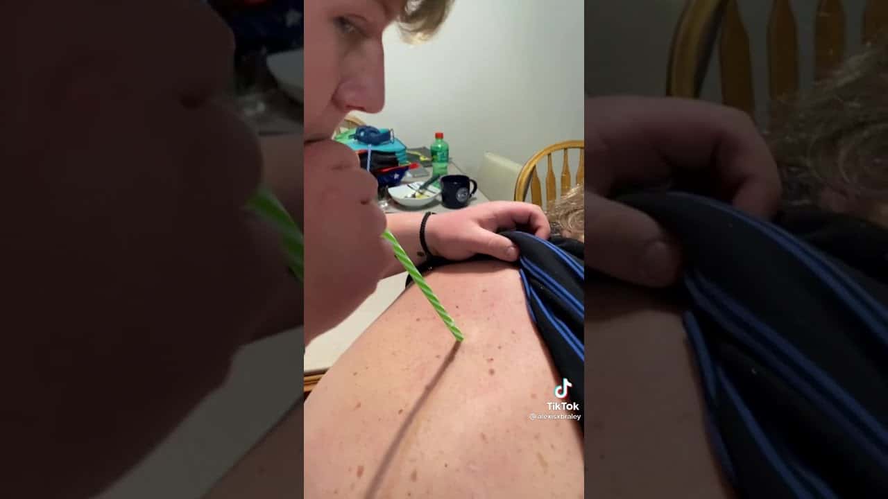 Grossest cyst pop you’ve ever seen. Wait for it