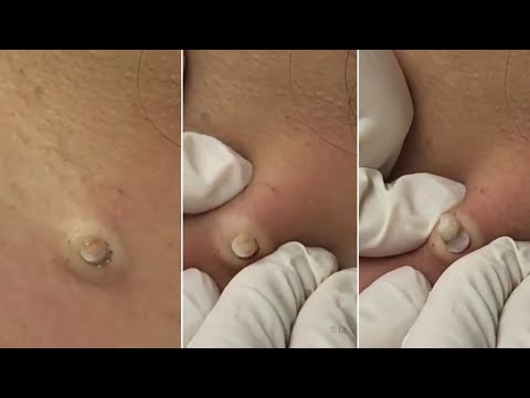 Grossest worst and most disgusting pimple popping