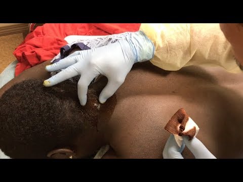 growth on back of neck gets drained