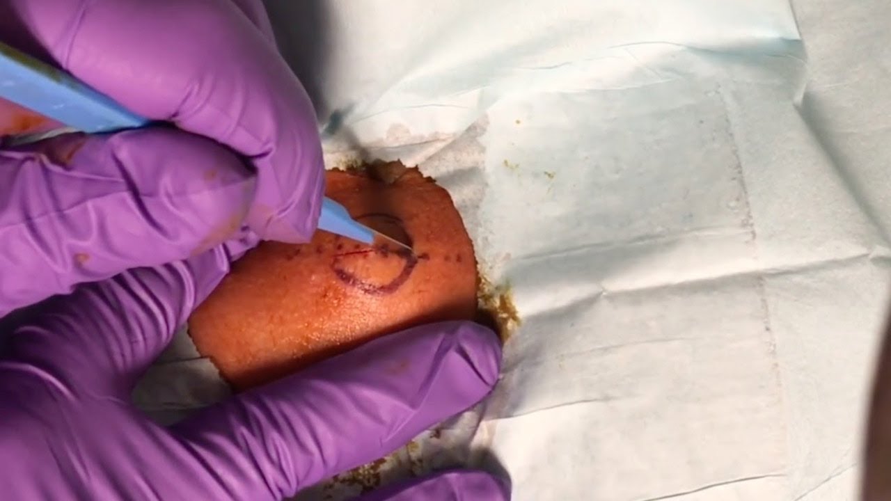 Gruesome Cyst Popped At Base Of Neck
