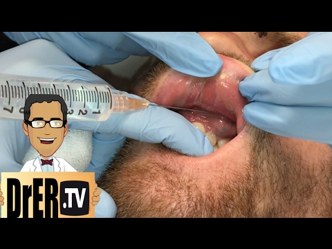 gum abscess drainage – Full VIDEO