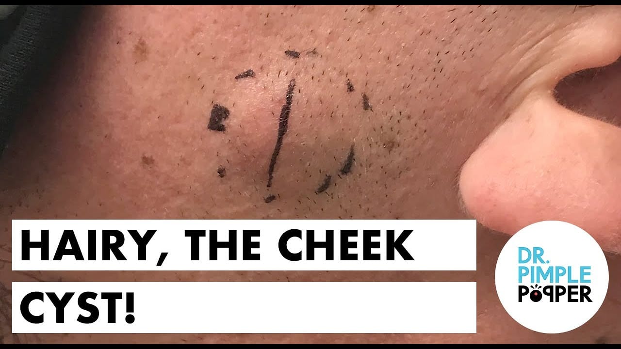 Hairy, The Cheek Cyst
