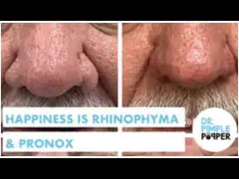 Happiness is Rhinophyma Removal + Pronox