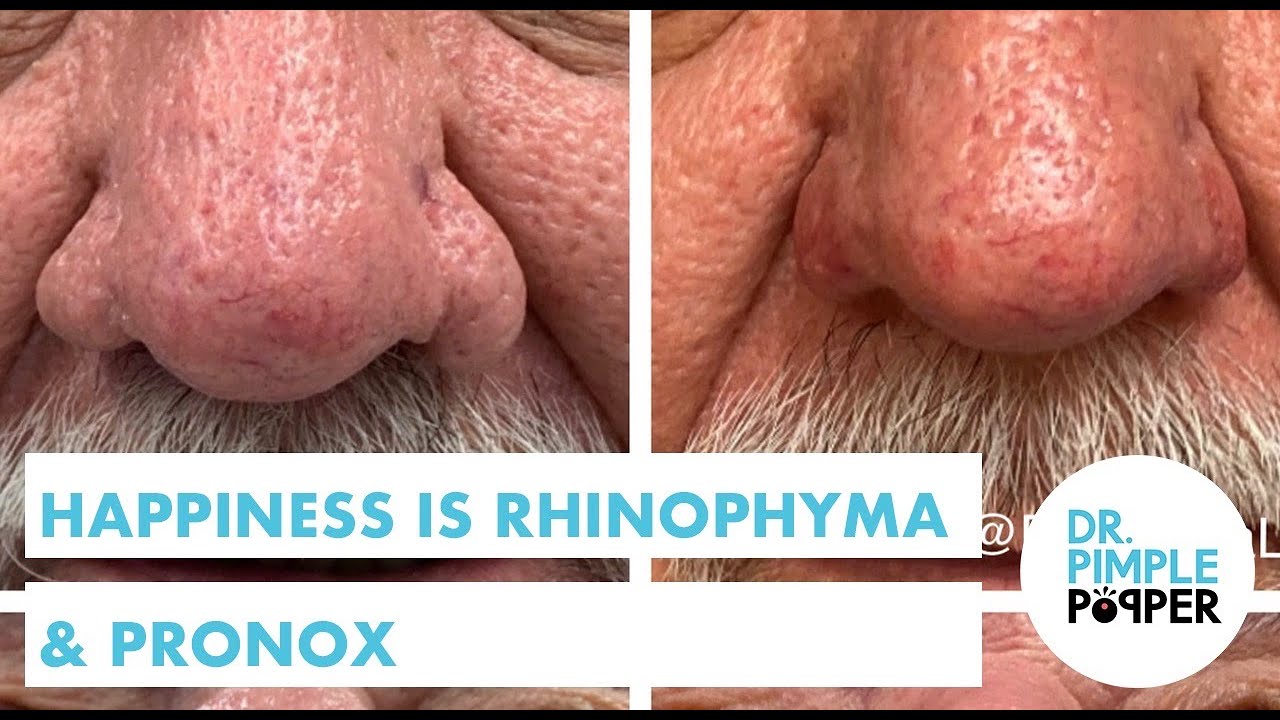 Happiness… is Rhinophyma Repair + Pronox!