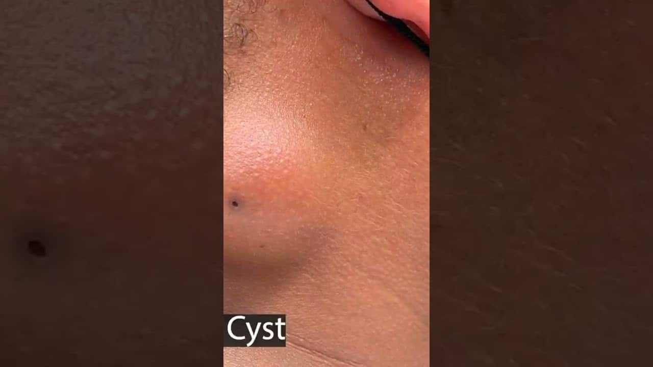 Have you watched the Jelly Oatmeal Cyst yet? #drpimplepopper #cyst #pimplepopping #shocking