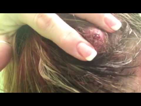 Head Cyst Popped!