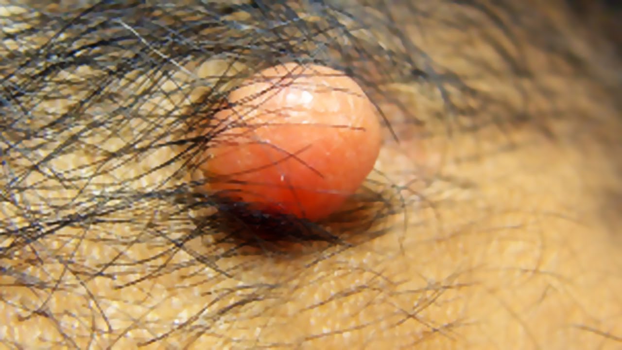 Head Cysts, Cyst Causes, Pilar Cysts & Popping!