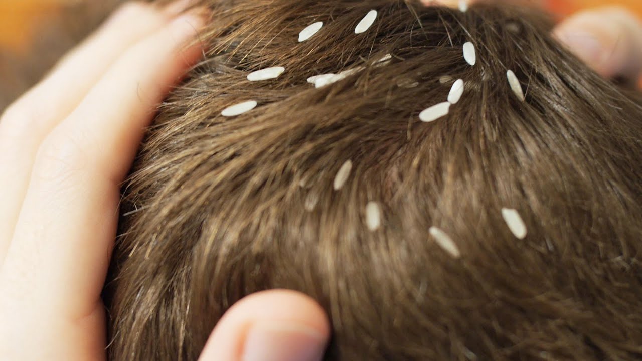 HEAD LICE??? HOW TO GET RID OF HEAD LICE FAST EASY// TMI Tuesdays
