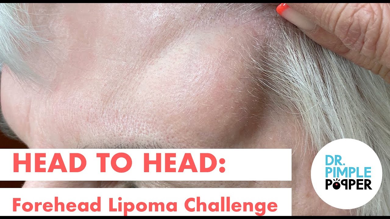 Head to Head: Forehead Lipoma Challenge – Challenger 2