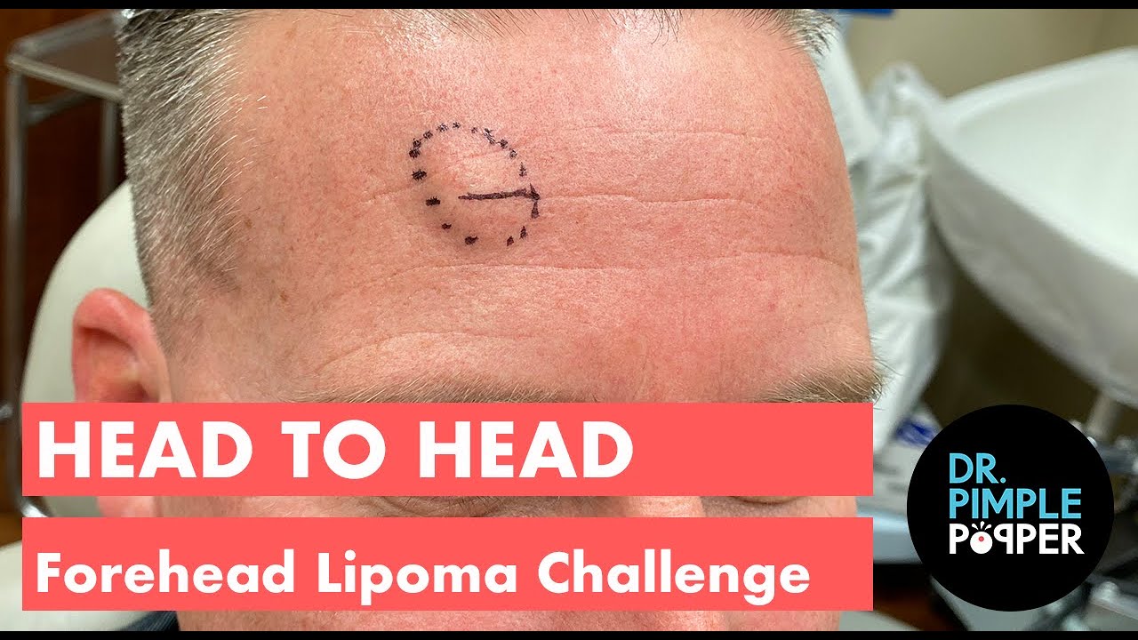 Head to Head: Forehead Lipomas Challenge – Challenger 1