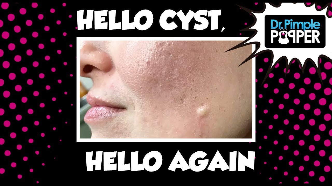 Hello cyst Again, Hello…