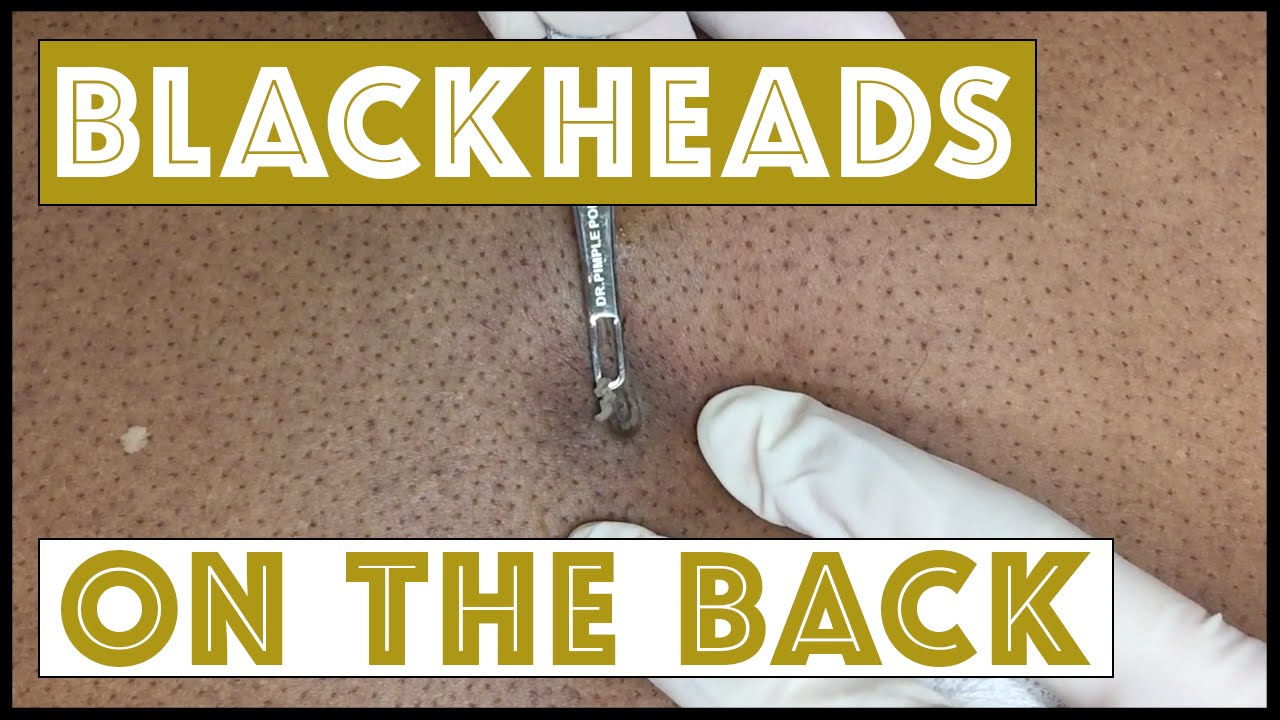 Here’s a Blackhead turn cyst that kept on going