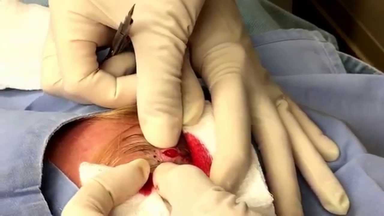 Here’s a pilar cyst removal which turned into three cysts. For medical education- NSFE.