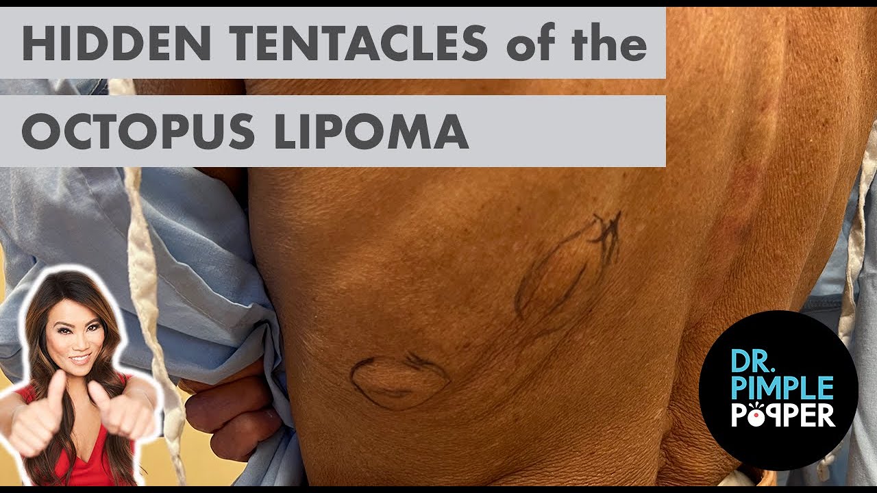 Hidden Tentacles of the Octopus Lipoma