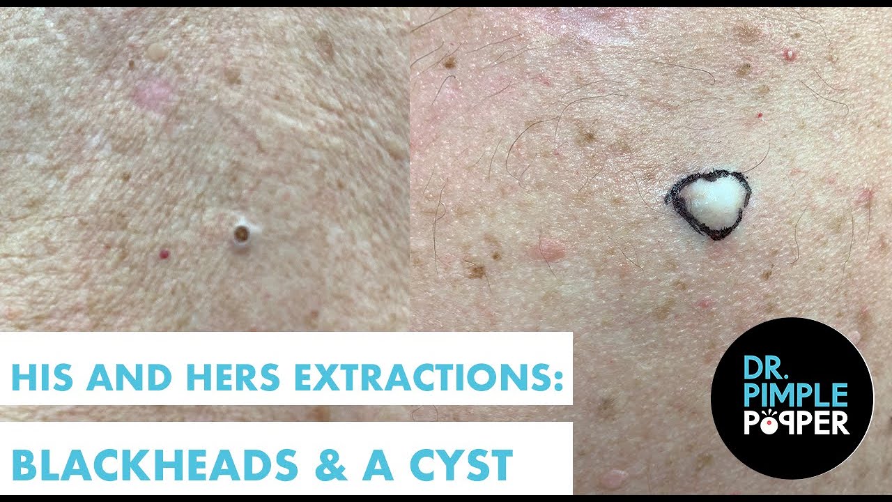 His and Hers Extractions: Blackheads & A Cyst