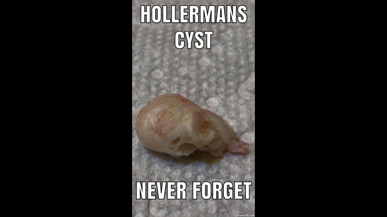 Hollerman's cyst…never forget